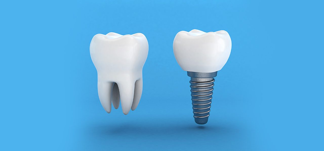 https://dentalzone.ca/wp-content/uploads/2022/09/How-long-after-extraction-can-you-get-an-implant-1280x600.jpg