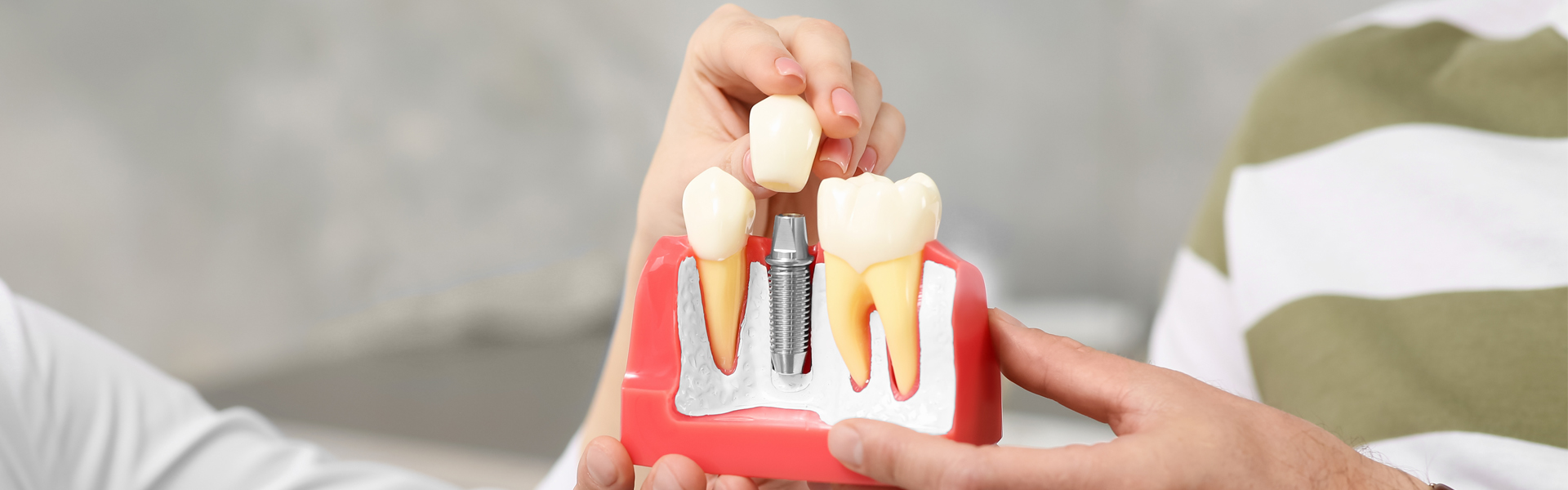 Is it better to get implants right after extraction
